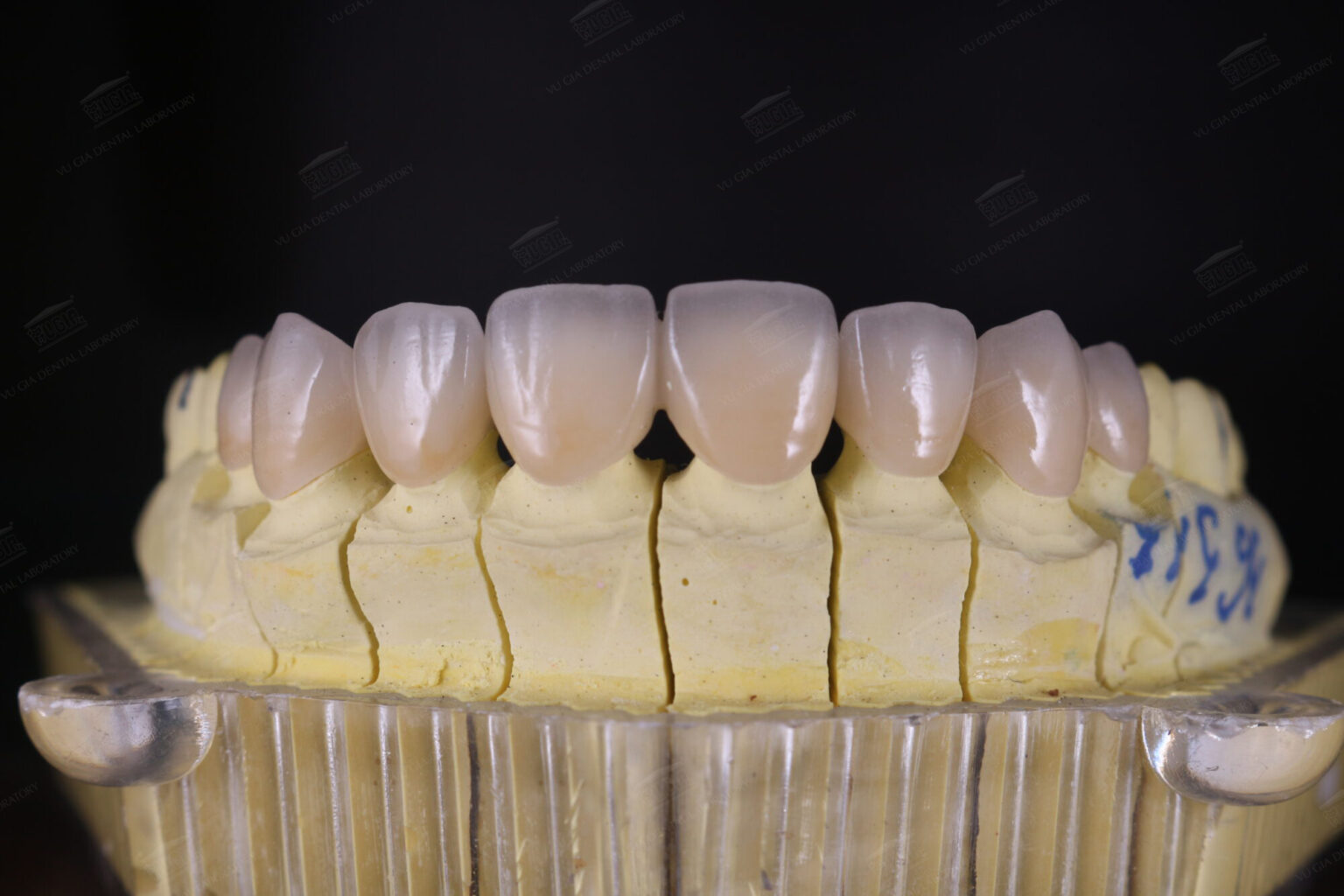 Răng sứ E-Max zir cad